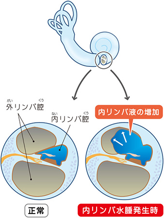 内耳(正常・内リンパ水腫)