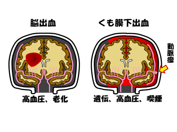 脳出血（高血圧、廊下）くも膜下出血（遺伝、高血圧、喫煙）